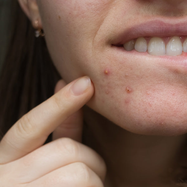 Unreine Haut - Die wichtigsten Pflegetipps bei Akne
